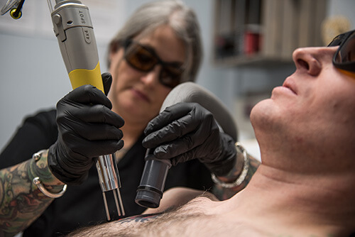 Lansing Laser tattoo removal process close up.